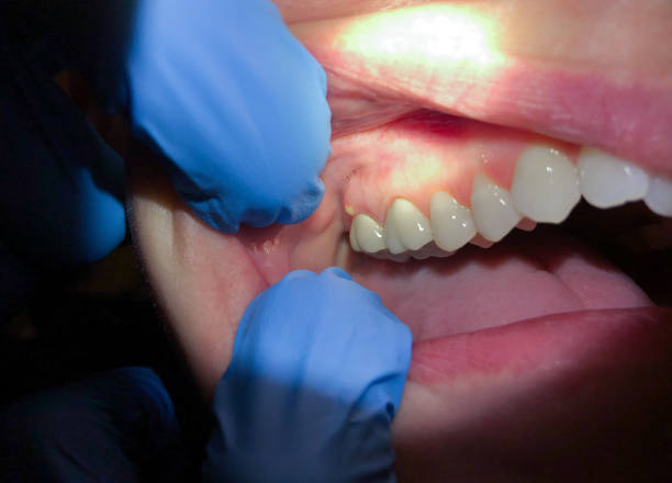Best Emergency Dental Care for Broken or Chipped Teeth in Mcleansville, NC